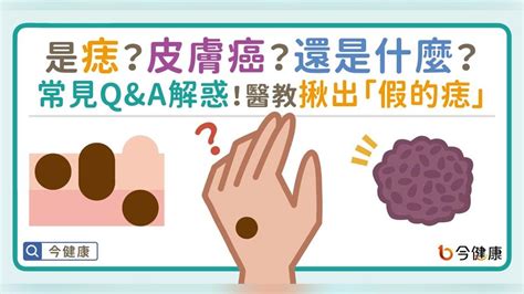 會長大的痣|是痣？皮膚癌？還是什麼？常見Q&A解惑！醫教揪出「假的痣」